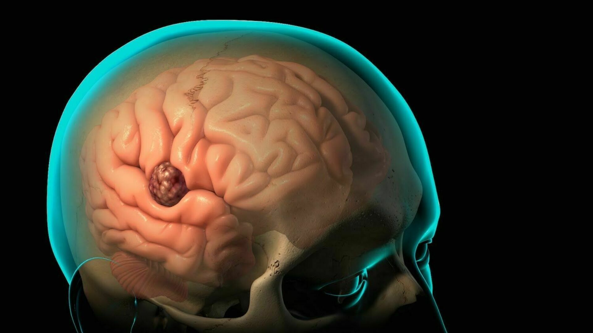 Злокачественное новообразование мозга